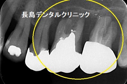 骨が非常に薄い上顎奥歯に人工骨を使わない(グラフトレス)インプラント治療
