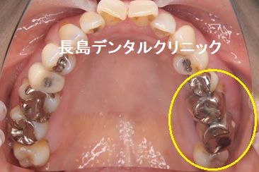 骨が非常に薄い上顎奥歯に人工骨を使わない(グラフトレス)インプラント治療