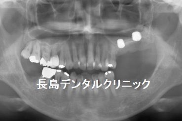 骨が非常に薄い上顎奥歯に人工骨を使わない(グラフトレス)インプラント治療