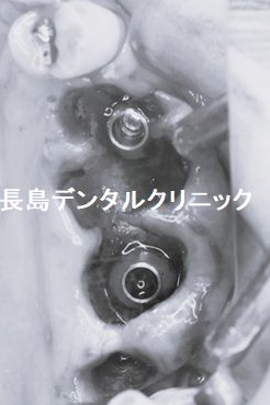 骨が非常に薄い上顎奥歯に人工骨を使わない(グラフトレス)インプラント治療