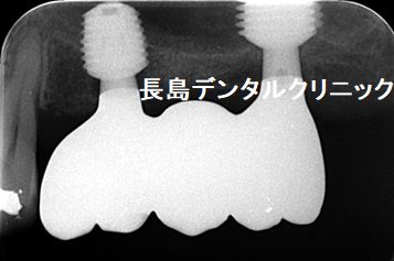 骨が非常に薄い上顎奥歯に人工骨を使わない(グラフトレス)インプラント治療