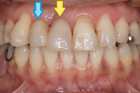 上顎前歯に1本インプラントを埋入し、その上に1本ではなく2本のかぶせ物を装着した症例