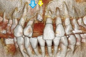 上顎前歯に1本インプラントを埋入し、その上に1本ではなく2本のかぶせ物を装着した症例