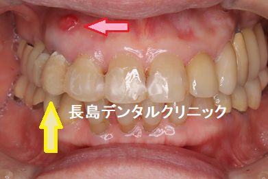 歯茎が腫れている右上3番(犬歯)に抜歯即時インプラント埋入を行った症例