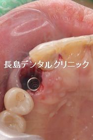 歯茎が腫れている右上3番(犬歯)に抜歯即時インプラント埋入を行った症例