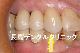 歯茎が腫れている右上3番(犬歯)に抜歯即時インプラント埋入を行った症例