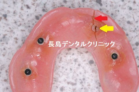 レジン床のインプラントオーバーデンチャーは割れやすいです