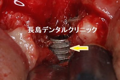 インプラントは破折することがあります