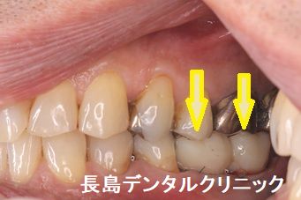 左下奥歯に2本即時荷重を行い仮歯を装着した症例 即時荷重後、注意する点は?