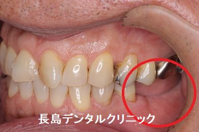 左下奥歯に2本即時荷重を行い仮歯を装着した症例 即時荷重後、注意する点は?