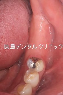 左下奥歯に2本即時荷重を行い仮歯を装着した症例 即時荷重後、注意する点は?