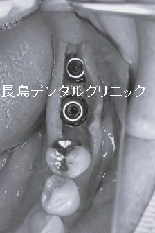左下奥歯に2本即時荷重を行い仮歯を装着した症例 即時荷重後、注意する点は?