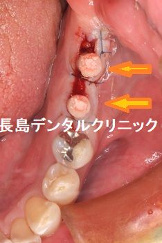左下奥歯に2本即時荷重を行い仮歯を装着した症例 即時荷重後、注意する点は?
