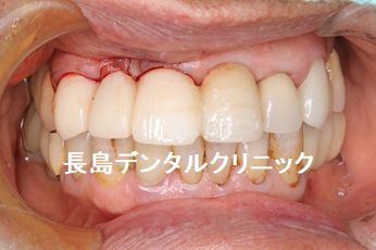 暫間インプラントを使い上顎前歯に2本のインプラントを埋入しインプラントブリッジを装着した症例