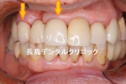 暫間インプラントを使い上顎前歯に2本のインプラントを埋入しインプラントブリッジを装着した症例