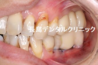 即時荷重インプラント埋入によって左下奥歯に2本のインプラントを埋入し、その上に仮歯のブリッジを装着しインプラント手術を終えた症例