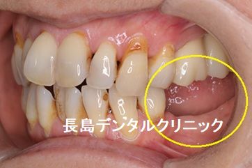 即時荷重インプラント埋入によって左下奥歯に2本のインプラントを埋入し、その上に仮歯のブリッジを装着しインプラント手術を終えた症例