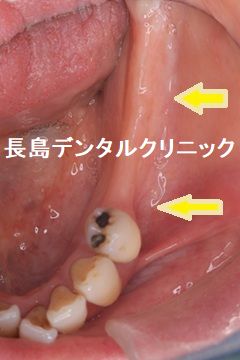 即時荷重インプラント埋入によって左下奥歯に2本のインプラントを埋入し、その上に仮歯のブリッジを装着しインプラント手術を終えた症例