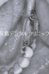 即時荷重インプラント埋入によって左下奥歯に2本のインプラントを埋入し、その上に仮歯のブリッジを装着しインプラント手術を終えた症例