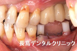 即時荷重インプラント埋入によって左下奥歯に2本のインプラントを埋入し、その上に仮歯のブリッジを装着しインプラント手術を終えた症例