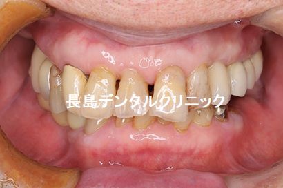 左下奥歯に2本のインプラントを使いインプラントブリッジを装着した症例