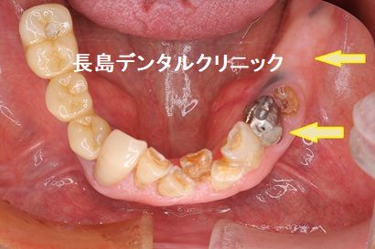 左下奥歯に2本のインプラントを使いインプラントブリッジを装着した症例