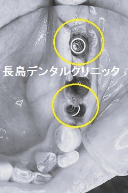 左下奥歯に2本のインプラントを使いインプラントブリッジを装着した症例