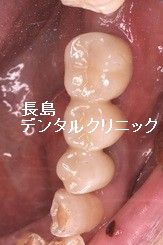 左下奥歯に2本のインプラントを使いインプラントブリッジを装着した症例