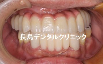 歯周病のため上顎すべての歯を抜歯し即時荷重を行いQOLの低下を防ぐためその日に仮歯を装着し、ジルコニアブリッジで治療を終えた症例