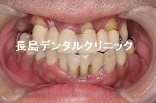 歯周病のため上顎すべての歯を抜歯し即時荷重を行いQOLの低下を防ぐためその日に仮歯を装着し、ジルコニアブリッジで治療を終えた症例