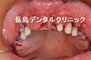 歯周病のため上顎すべての歯を抜歯し即時荷重を行いQOLの低下を防ぐためその日に仮歯を装着し、ジルコニアブリッジで治療を終えた症例