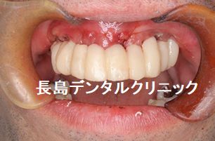 歯周病のため上顎すべての歯を抜歯し即時荷重を行いQOLの低下を防ぐためその日に仮歯を装着し、ジルコニアブリッジで治療を終えた症例