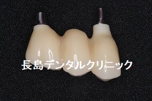 歯周病のため上顎すべての歯を抜歯し即時荷重を行いQOLの低下を防ぐためその日に仮歯を装着し、ジルコニアブリッジで治療を終えた症例 上顎のかぶせ物の説明