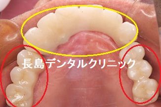 歯周病のため上顎すべての歯を抜歯し即時荷重を行いQOLの低下を防ぐためその日に仮歯を装着し、ジルコニアブリッジで治療を終えた症例 上顎のかぶせ物の説明