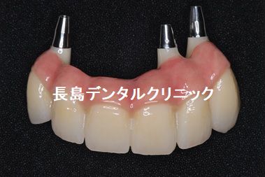 歯周病のため上顎すべての歯を抜歯し即時荷重を行いQOLの低下を防ぐためその日に仮歯を装着し、ジルコニアブリッジで治療を終えた症例 上顎のかぶせ物の説明