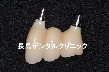 歯周病のため上顎すべての歯を抜歯し即時荷重を行いQOLの低下を防ぐためその日に仮歯を装着し、ジルコニアブリッジで治療を終えた症例 上顎のかぶせ物の説明