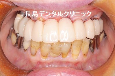 上顎の埋入した4本のインプラントを支えにして10歯つながったインプラントブリッジを装着した症例その1