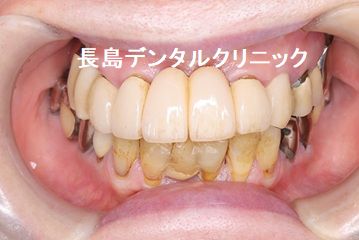 上顎の埋入した4本のインプラントを支えにして10歯つながったインプラントブリッジを装着した症例その1