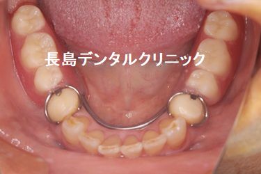 上下の歯を失い噛む場所が少なくなった患者様を8本のインプラントを使いかみ合わせを改善できた症例