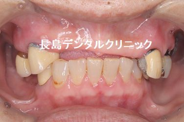 上下の歯を失い噛む場所が少なくなった患者様を8本のインプラントを使いかみ合わせを改善できた症例