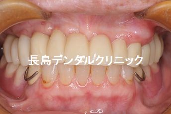 上下の歯を失い噛む場所が少なくなった患者様を8本のインプラントを使いかみ合わせを改善できた症例