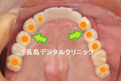 上下の歯を失い噛む場所が少なくなった患者様を8本のインプラントを使いかみ合わせを改善できた症例