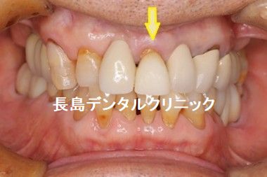 上顎前歯1本抜歯から即時荷重し仮歯の装着までのインプラント手術の流れ その1
