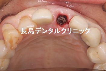 上顎前歯1本抜歯から即時荷重し仮歯の装着までのインプラント手術の流れ その1