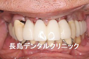 上顎前歯4本ブリッジを2本のインプラントを使い再度ブリッジで治療を終えた症例