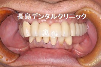 上顎前歯4本ブリッジを2本のインプラントを使い再度ブリッジで治療を終えた症例