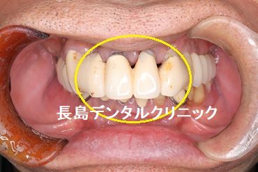 上顎前歯4本ブリッジを2本のインプラントを使い再度ブリッジで治療を終えた症例