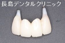 上顎前歯4本ブリッジを2本のインプラントを使い再度ブリッジで治療を終えた症例