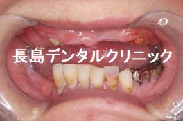 上下すべての歯を抜歯し上顎に7本下顎には6本のインプラントを使い、口腔機能を回復した症例