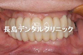 上下すべての歯を抜歯し上顎に7本下顎には6本のインプラントを使い、口腔機能を回復した症例